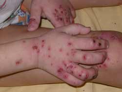 Герпетические высыпания на коже предплечий у 4-х летнего ребенка