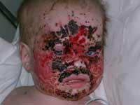 Массивные геморрагические корки на лице у 8-месячного ребенка